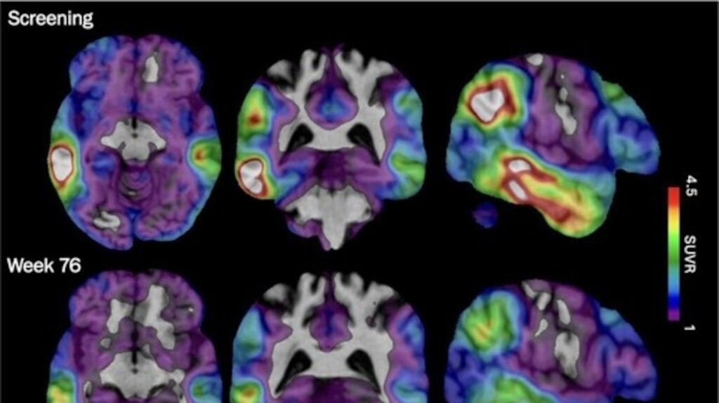 Experimental Alzheimer’s drug shows some promise as researchers hunt new approaches