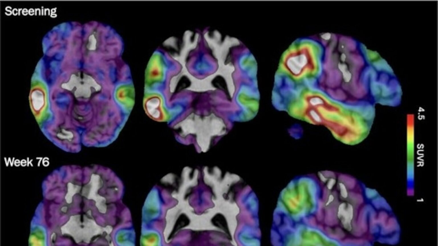 Experimental Alzheimer’s drug shows some promise as researchers hunt new approaches