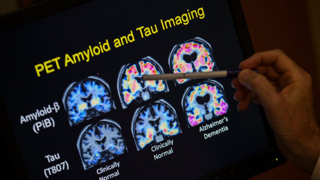 Want to lower your risk of dementia? It doesn’t involve a blood test